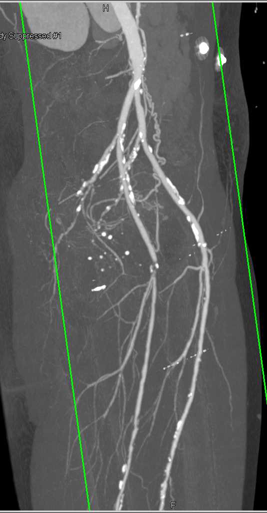 CTA Runoff with Peripheral Vascular Disease - CTisus CT Scan