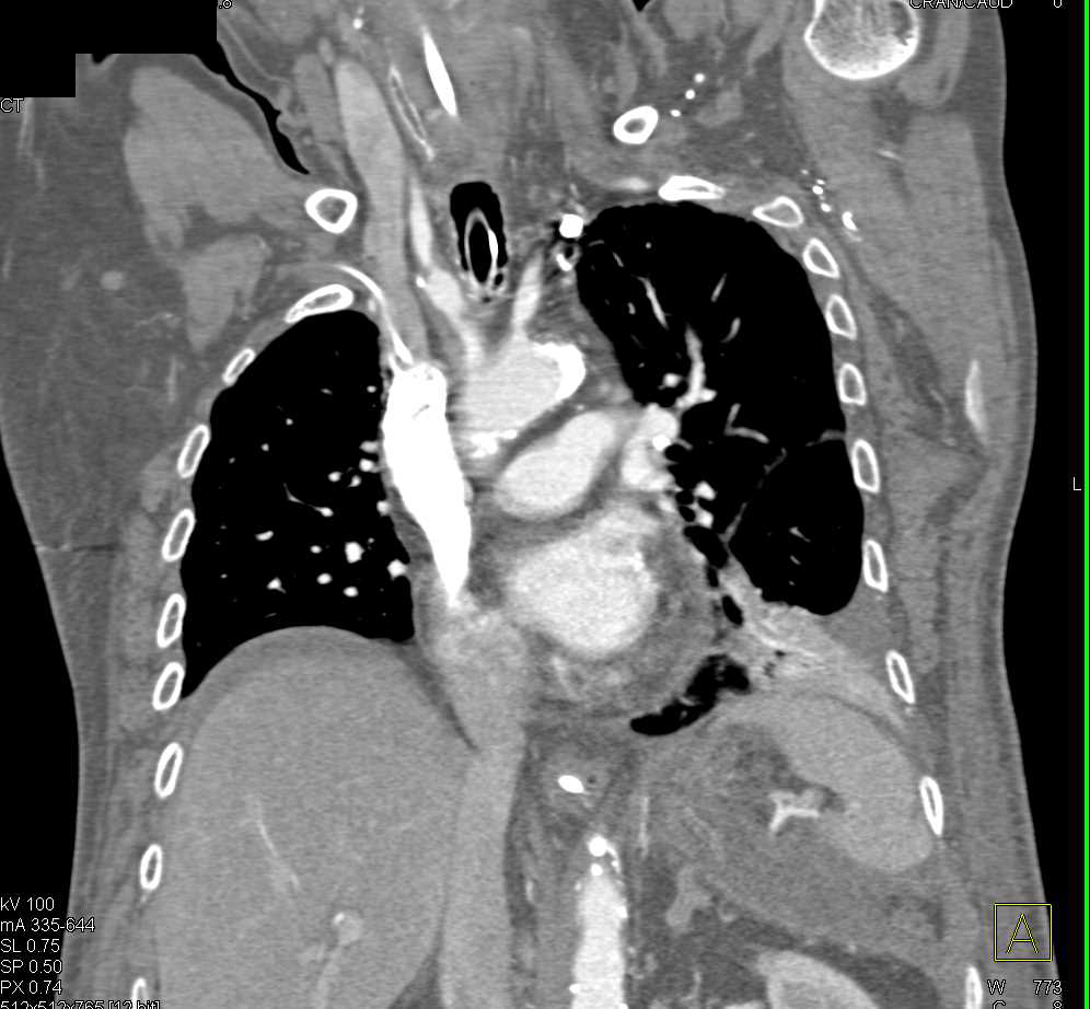 Vascular Disease in the Branch Vessels - CTisus CT Scan