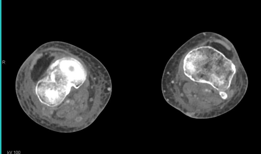 Multiple Venous Clots in Inferior Vena Cava (IVC) through Femoral and Popliteal Veins - CTisus CT Scan