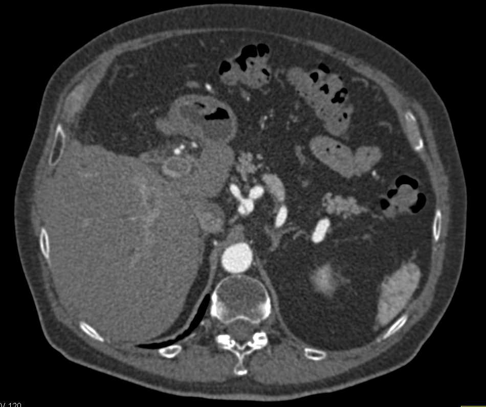 Dissection of Celiac Artery - CTisus CT Scan