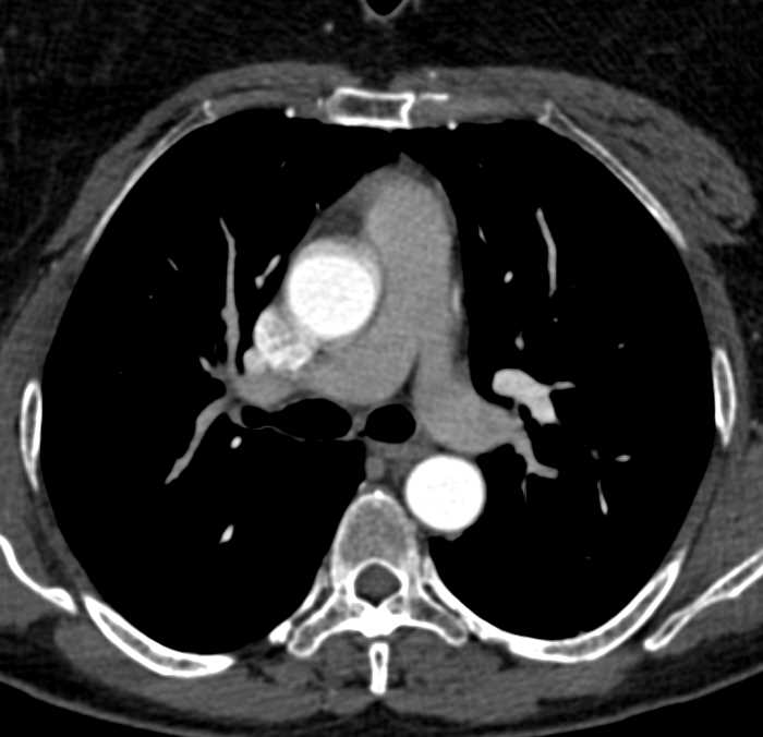 Pseudo-Dissection Aortic Root - CTisus CT Scan