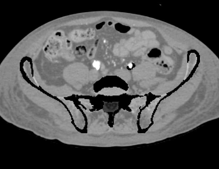 DE with Vascular Maps with Bypass Grafts due to Native Superficial Femoral Artery (SFA) Disease - CTisus CT Scan