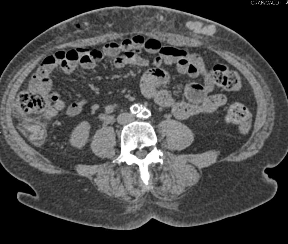 Complex Stent Repair with Multiple Grafts - CTisus CT Scan