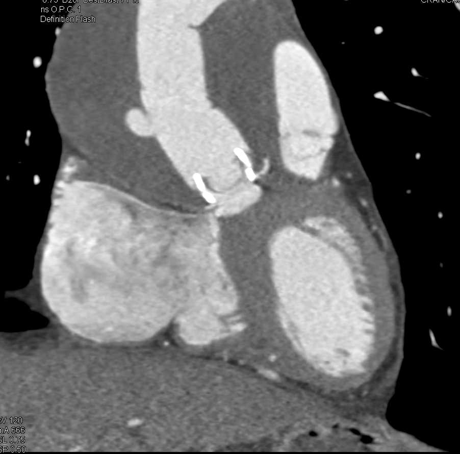 Repair of Type A Dissection with Pseudoaneurysm off Ascending Aorta - CTisus CT Scan