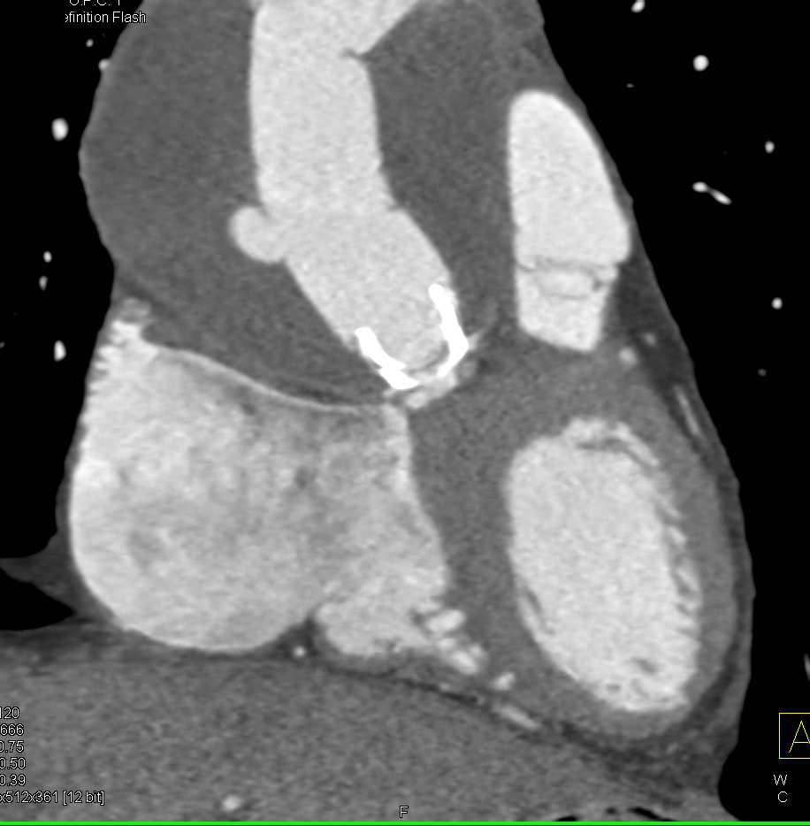 Repair of Type A Dissection with Pseudoaneurysm off Ascending Aorta - CTisus CT Scan