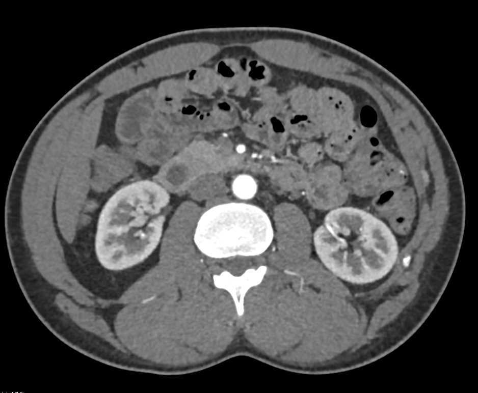 Normal Renal Arteries - CTisus CT Scan