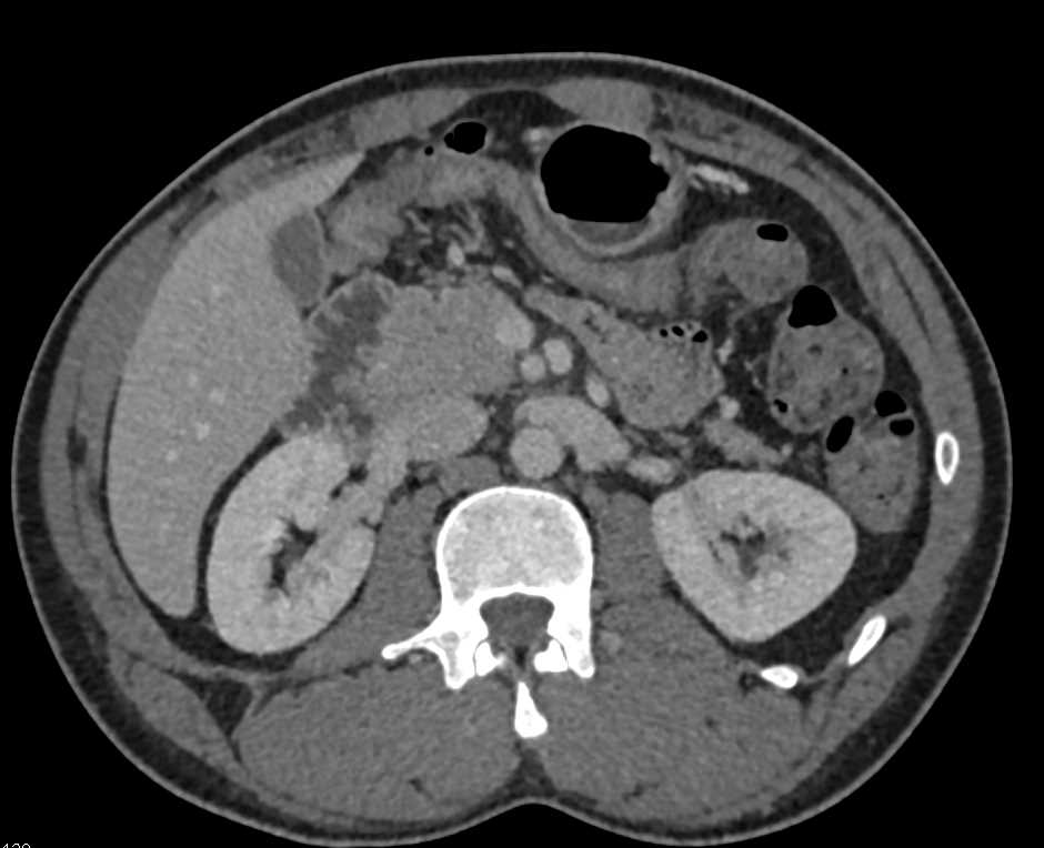 CTA Kidneys with 2 Right Renal Arteries - CTisus CT Scan