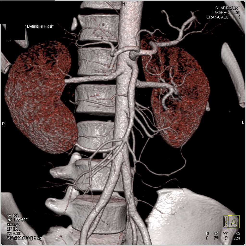 CTA Kidneys with 2 Right Renal Arteries - Vascular Case Studies ...