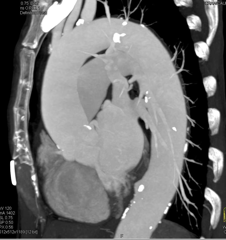 Ulcerating Plaque in Descending Thoracic Aorta - CTisus CT Scan