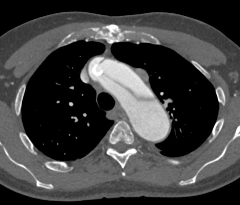 Aortic Dissection Extends into the Abdominal Aorta with Renal Arteries to Left Kidney off True and False Lumen - CTisus CT Scan