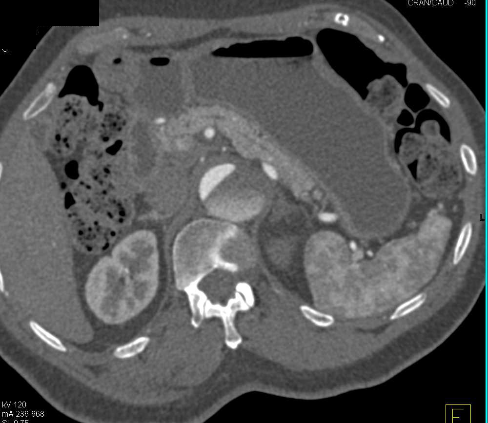 Aortic Dissection Extends into the Abdominal Aorta with Renal Arteries to Left Kidney off True and False Lumen - CTisus CT Scan