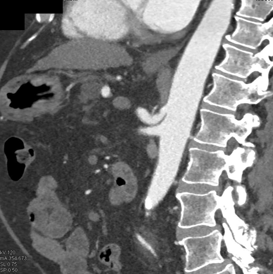 Median Arcuate Ligament Syndrome (MALS) - CTisus CT Scan