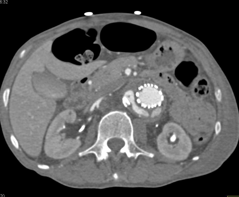 Large Endoleak - CTisus CT Scan