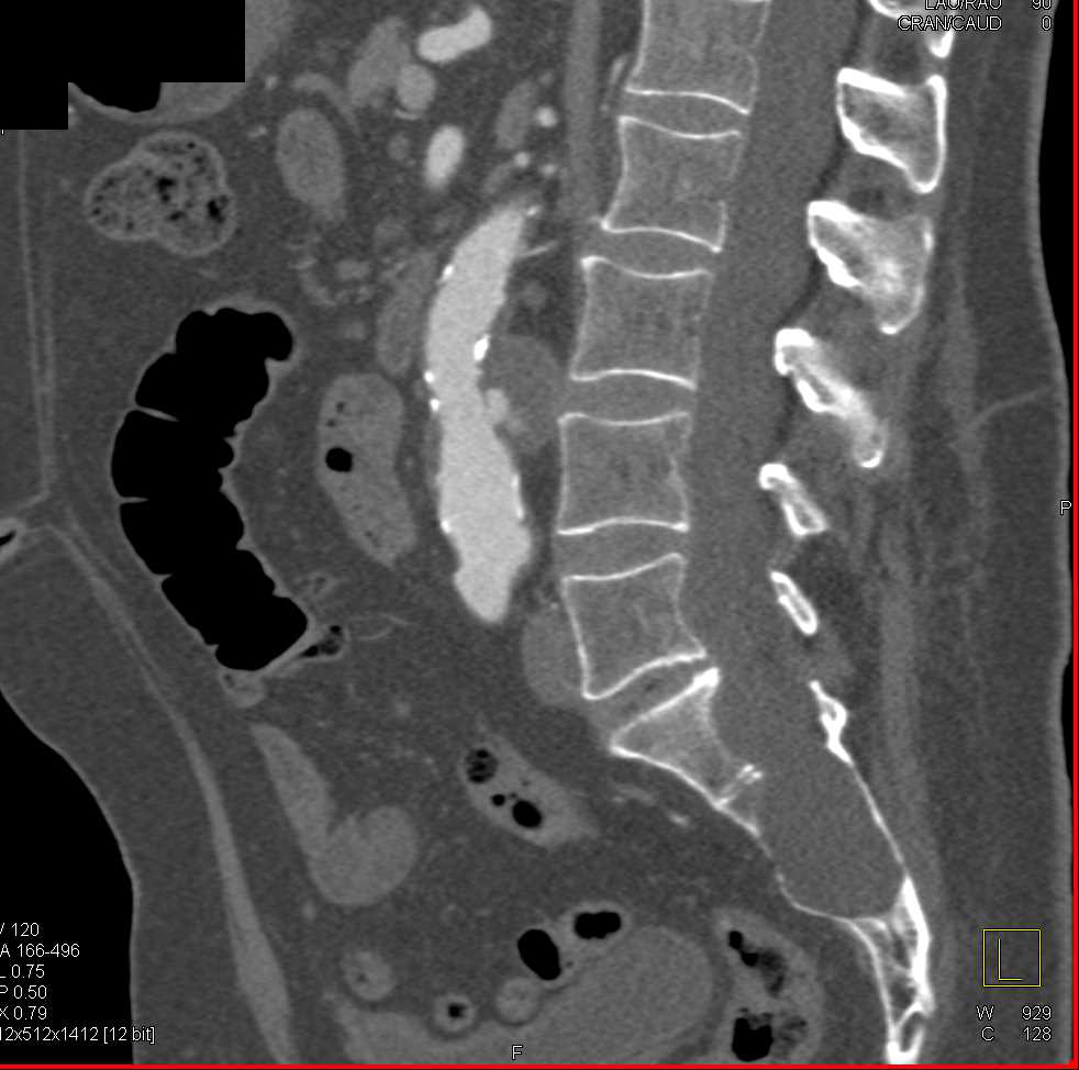 Ulceration Lower Abdominal Aorta - CTisus CT Scan