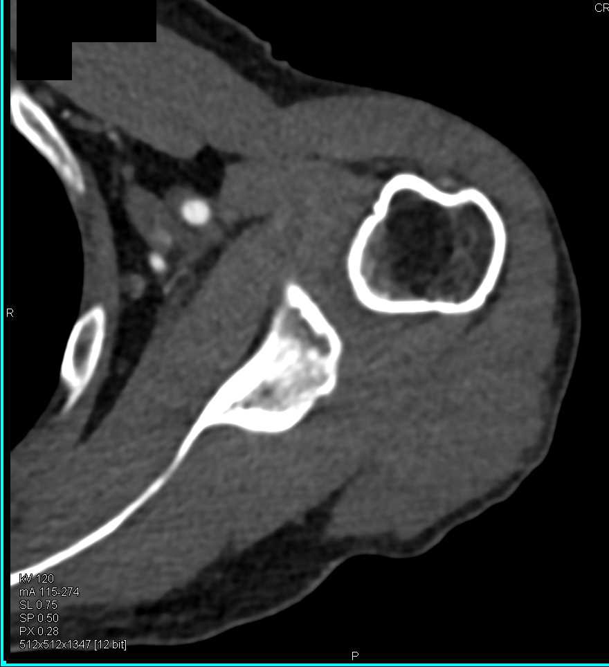 CTA Brachial Artery with Subtle Clot - CTisus CT Scan