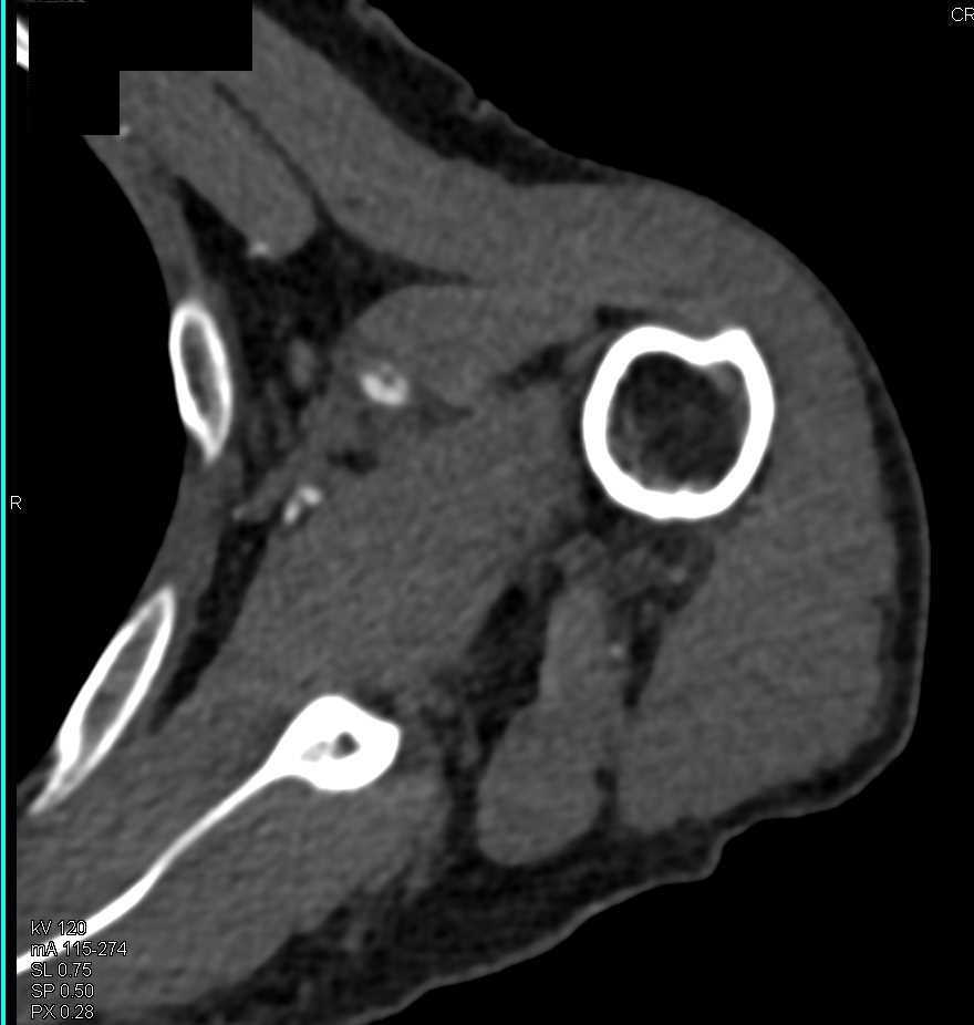 CTA Brachial Artery with Subtle Clot - CTisus CT Scan