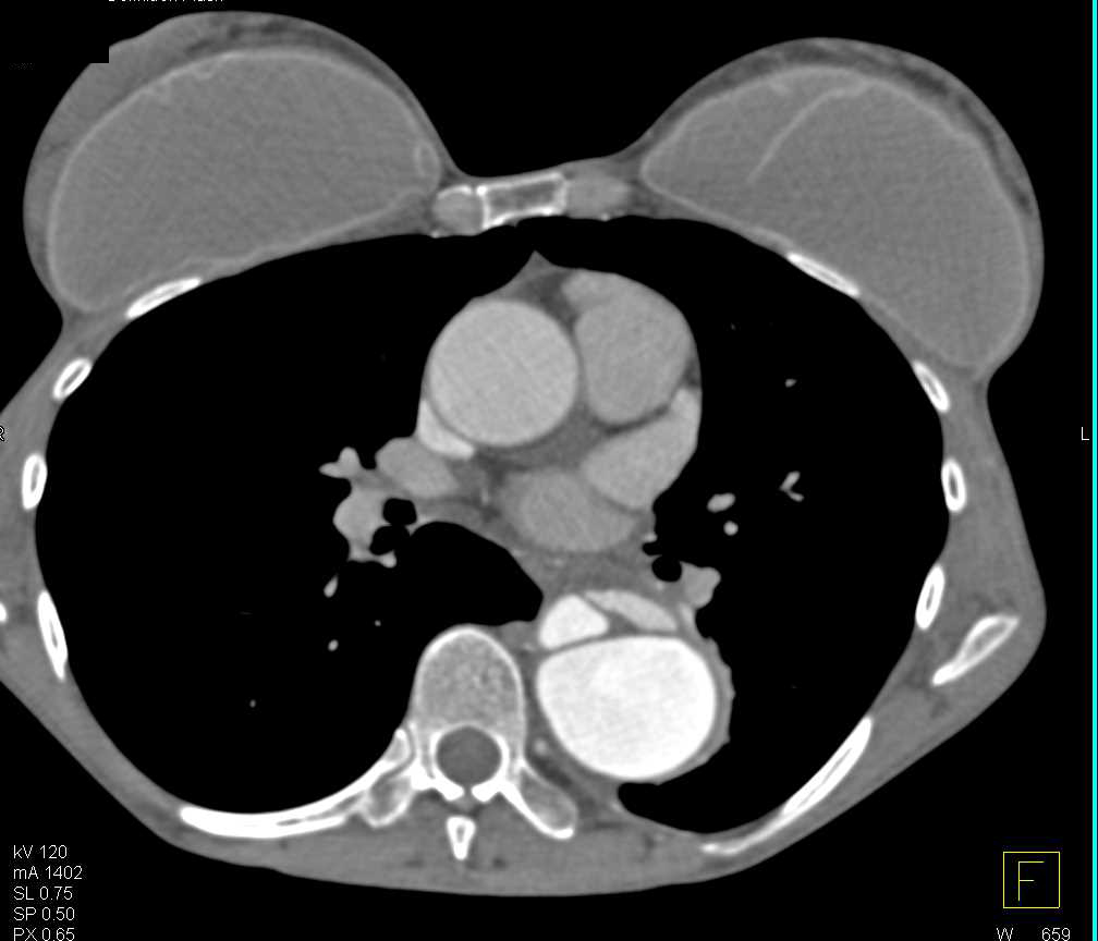 Type A Dissection Involves the Descending Thoracic Aorta - CTisus CT Scan