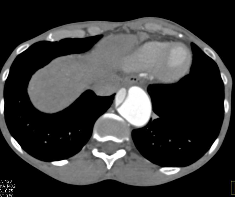 Type A Dissection Involves the Descending Thoracic Aorta - CTisus CT Scan