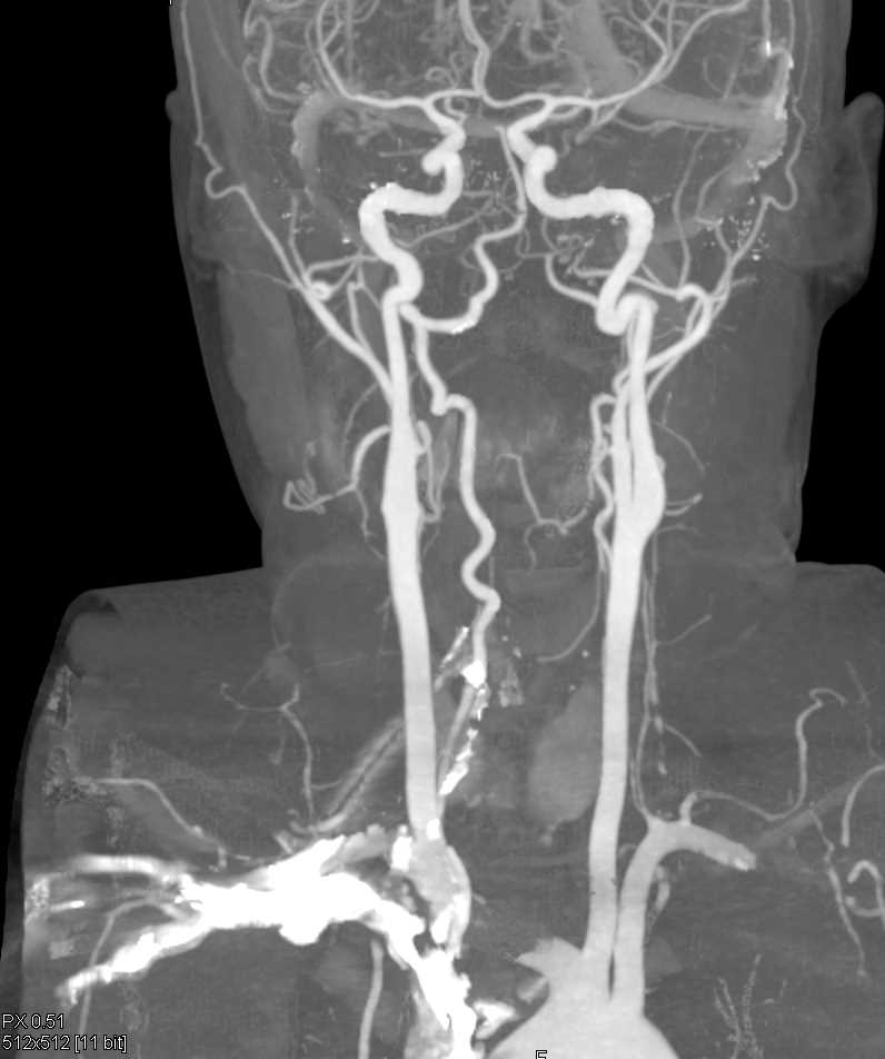 CTA with Pseudolesion due to Artifact off High Density Contrast-Pitfall - CTisus CT Scan