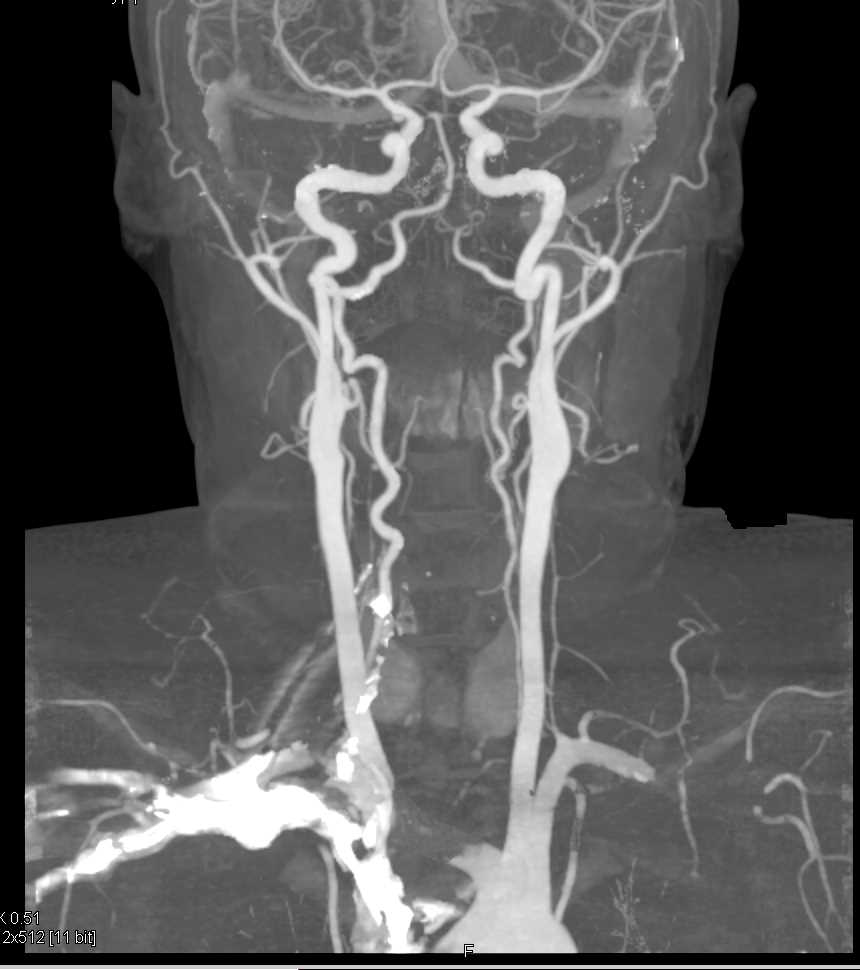 CTA with Pseudolesion due to Artifact off High Density Contrast-Pitfall - CTisus CT Scan