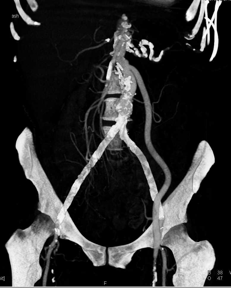 Aorto-Femoral Bypass Grafting - CTisus CT Scan