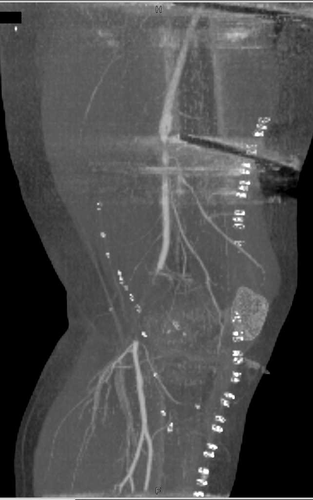 Popliteal Artery Occlusion - CTisus CT Scan