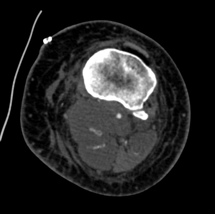 Thrombus in the Popliteal Artery - CTisus CT Scan