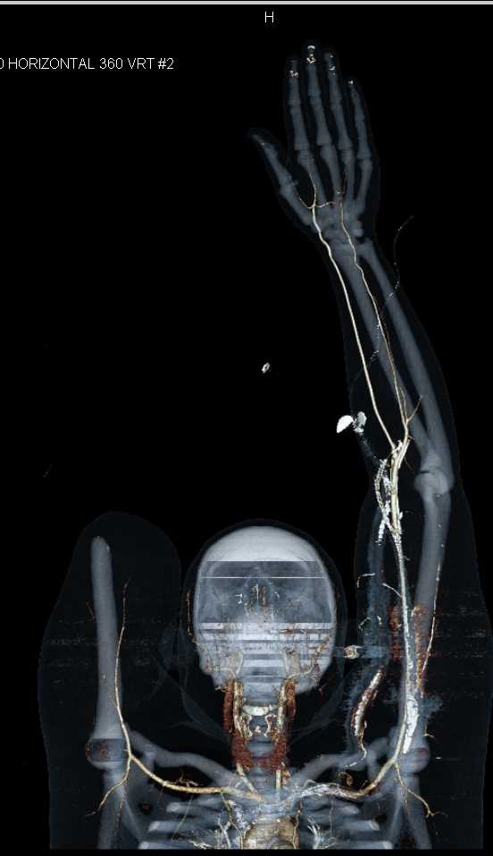 CTA with Dual Energy and Vascular Map for Reconstructive Surgery - CTisus CT Scan