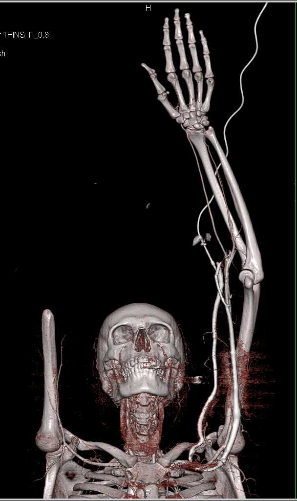 Dual Energy CTA for Vascular Mapping Prior to Reconstructive Surgery - CTisus CT Scan