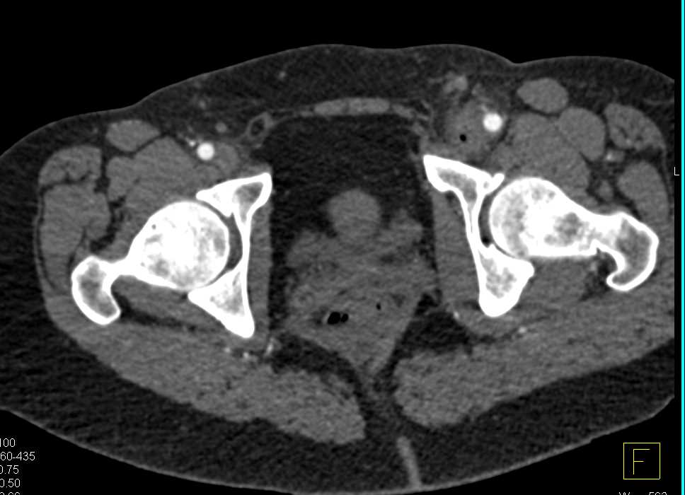 CTA with Good Vascular Map and Inguinal Adenopathy - CTisus CT Scan