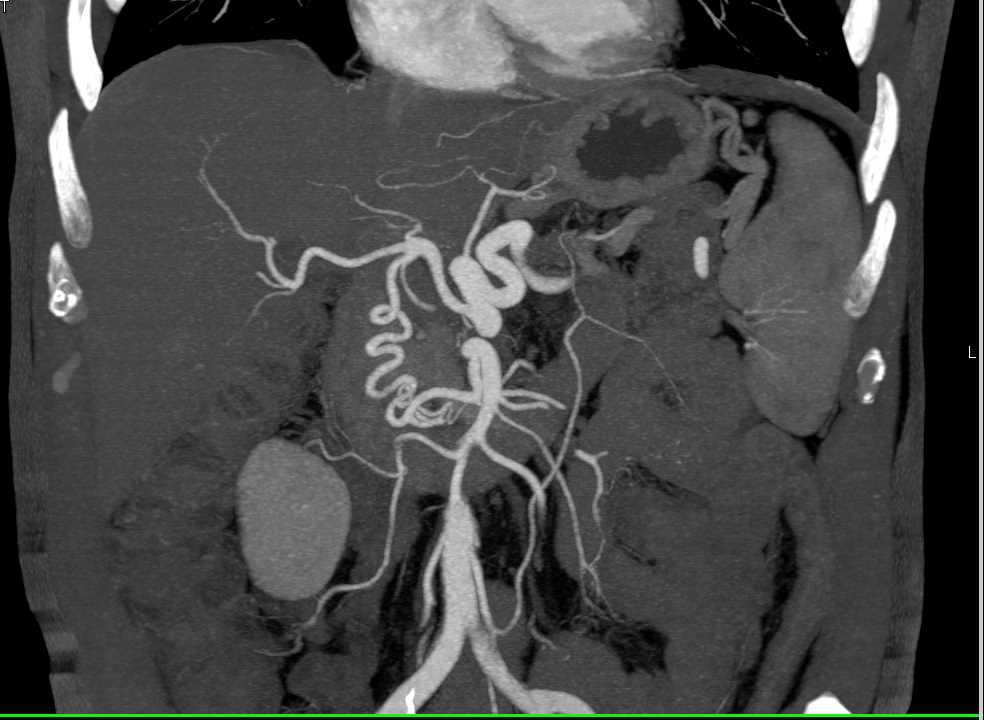 Prominent Gastroduodenal Artery (GDA) - CTisus CT Scan