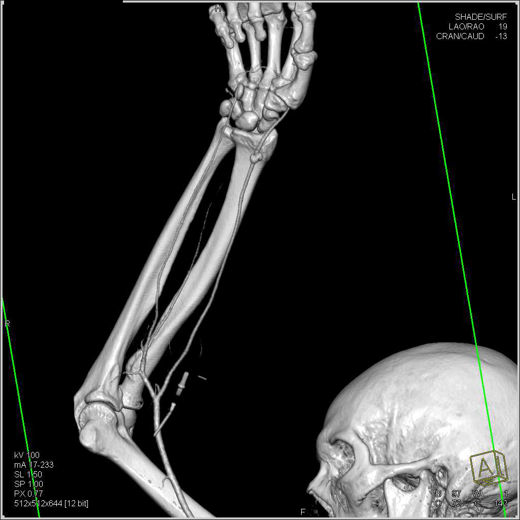 Pseudoaneurysm Distal Radial Artery - CTisus CT Scan