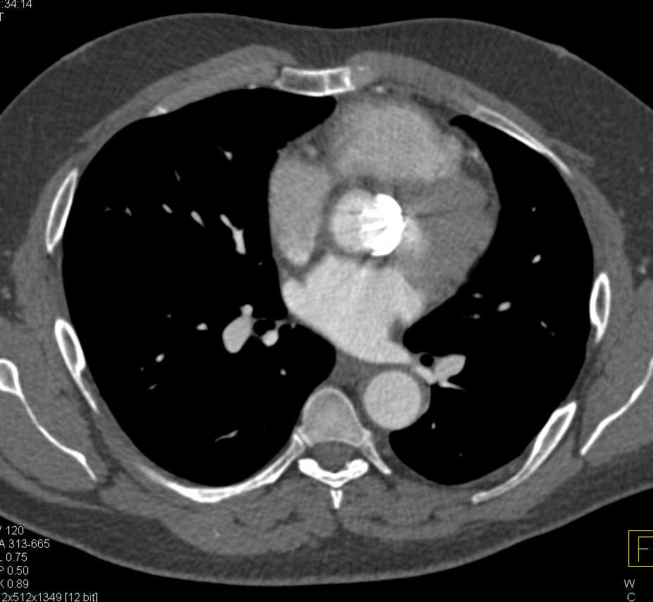 Aortic Dissection with Fem-Fem Bypass - CTisus CT Scan