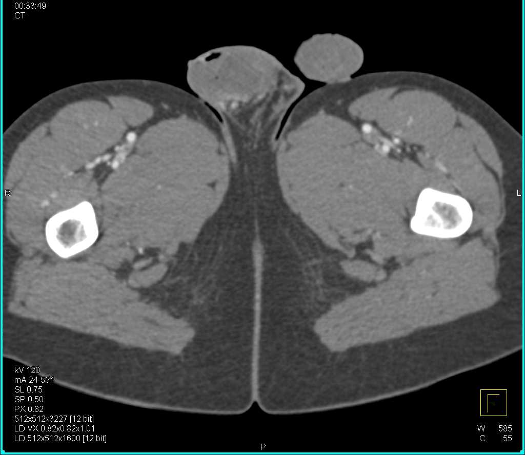 CTA Runoff with Normal Vessels through Trifurcation - CTisus CT Scan