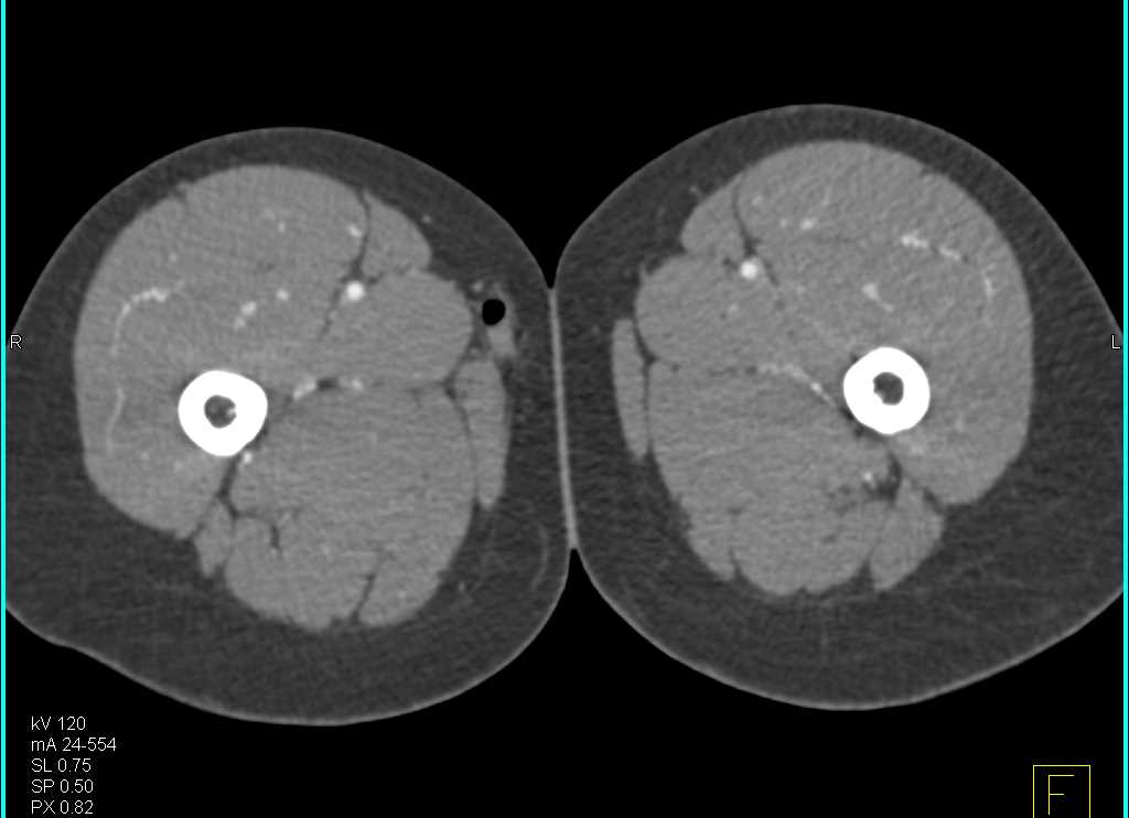 CTA Runoff with Normal Vascular Map - CTisus CT Scan