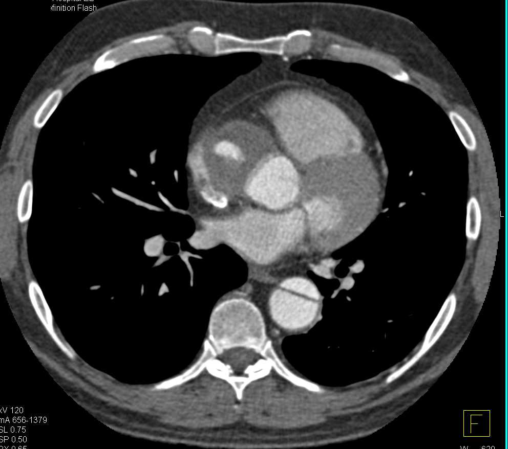 Type A Dissection with Repair and Descending Aorta Dissection - CTisus CT Scan