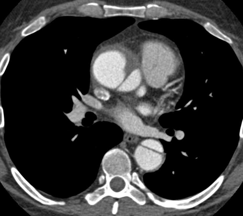 Type A Dissection with Repair and Descending Aorta Dissection - CTisus CT Scan