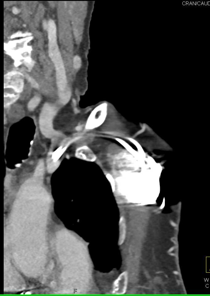 Arteriovenous (AV) Fistulae with Stenosis - CTisus CT Scan