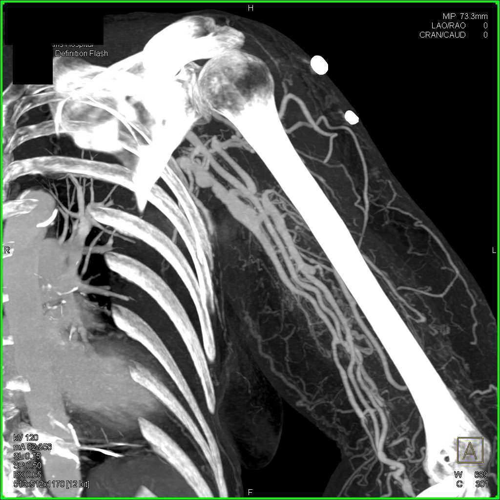 Arteriovenous (AV) Fistulae in Left Axillary Zone - CTisus CT Scan