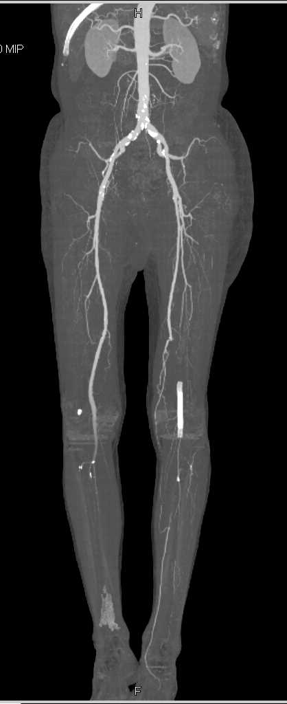 CTA Runoff with Peripheral Vascular Disease and Failed Stent - CTisus CT Scan