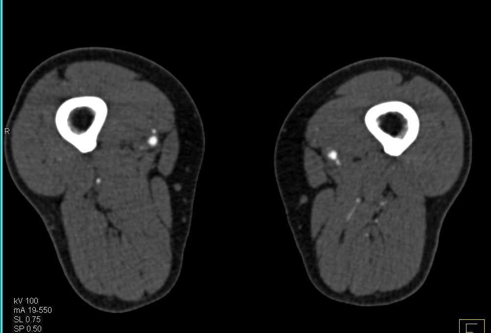 DE CTA Runoff with Vascular Disease on Left - CTisus CT Scan