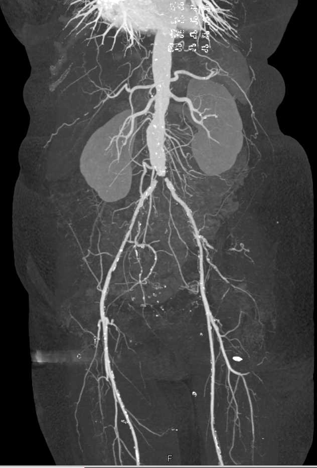 CTA Dual Energy with Pseudolesion Seen at Aortic Bifurcation - CTisus CT Scan