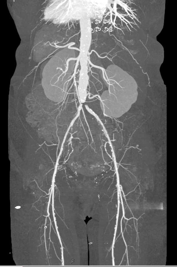 CTA Dual Energy with Pseudolesion Seen at Aortic Bifurcation - CTisus CT Scan