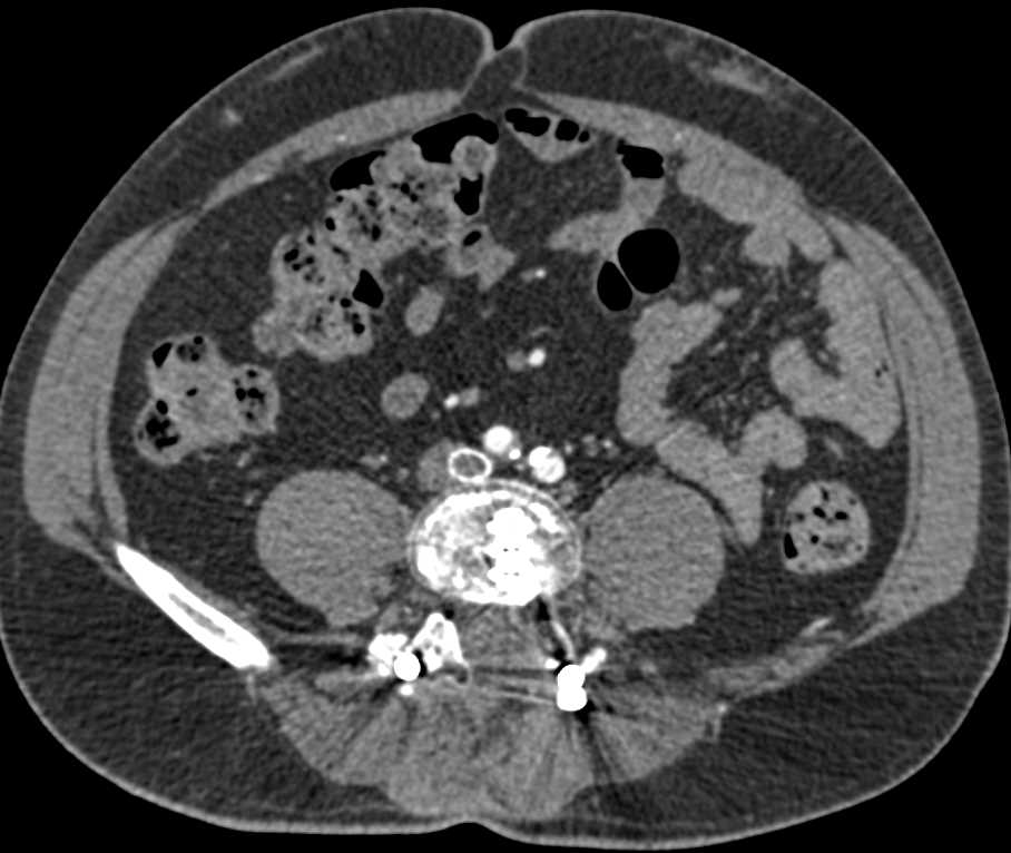 Occluded Left Iliac Vein Graft - CTisus CT Scan