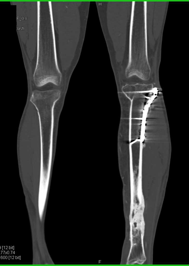 Prior Hardware with Patent Runoff Study - CTisus CT Scan