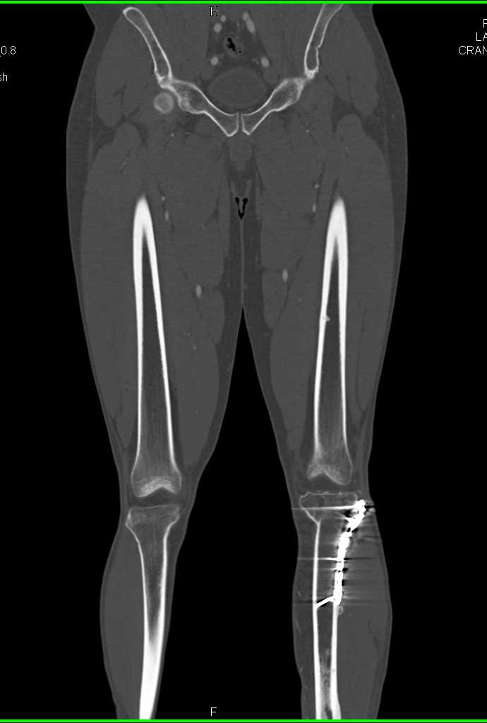 Prior Hardware with Patent Runoff Study - CTisus CT Scan