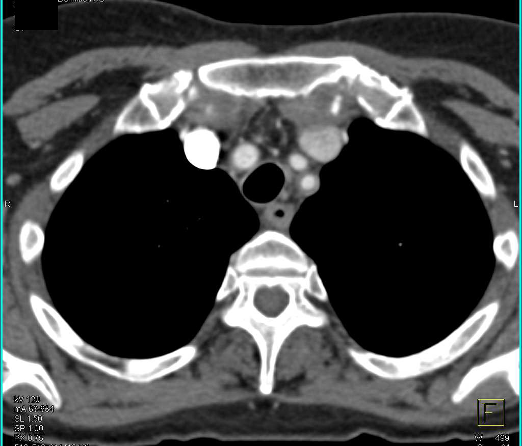 Takayasu's Arteritis Best Seen in Left Subclavian Artery and Abdominal Aorta - CTisus CT Scan