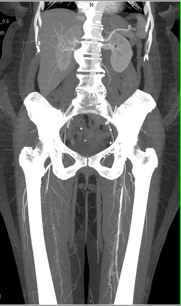 CTA Runoff with Peripheral Vascular Disease (PVD) and Right Superficial Femoral Artery (SFA) Occlusion - CTisus CT Scan