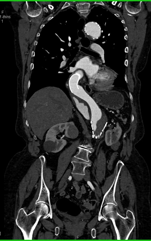 Aortic Aneurysm with Beading of the SMA - CTisus CT Scan