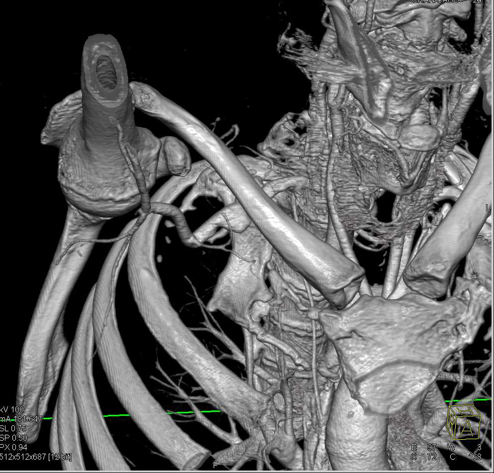 Pseudoaneurysm Right Subclavian Artery - CTisus CT Scan